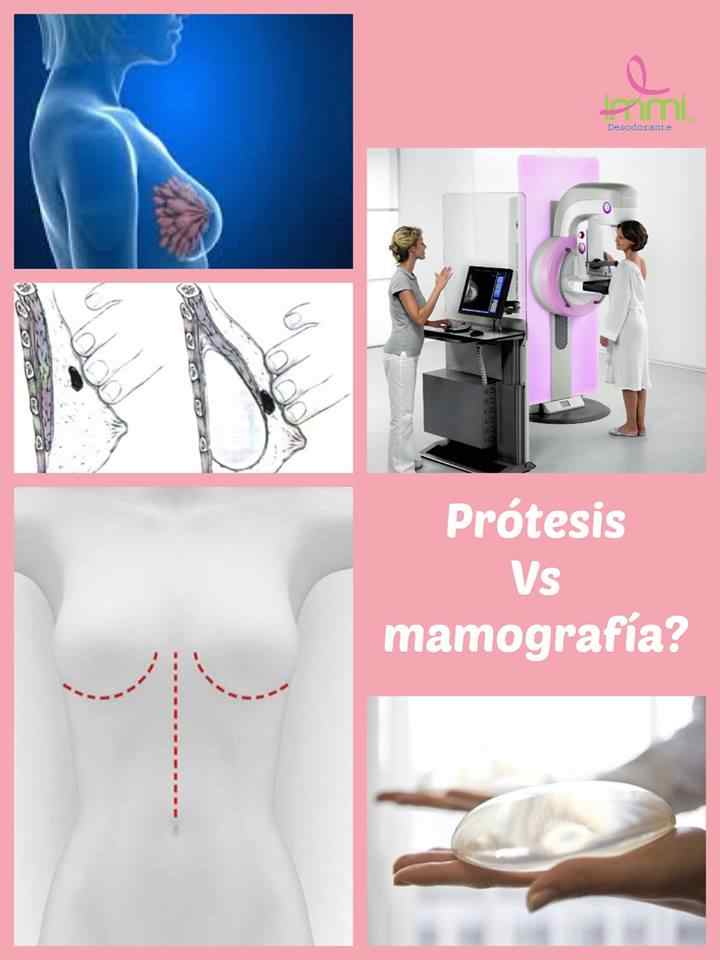 En este momento estás viendo Las mamografías y las prótesis